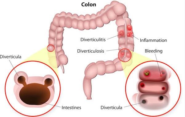 Diverticulitis Diverticulitis